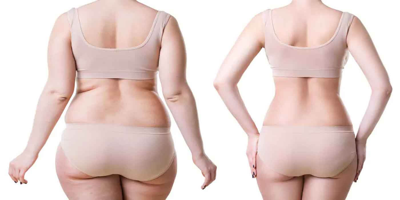 Before and After picture for liposuction